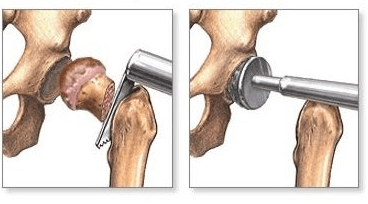 odcięcia kości udowej