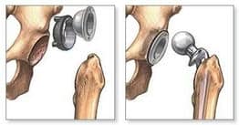 pogłębienia panewki