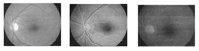 Angiografia fluoresceinowa