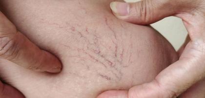 Czy żylaki zawsze trzeba usunąć?