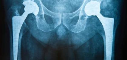 Kiedy niezbędna jest endoproteza stawu biodrowego?