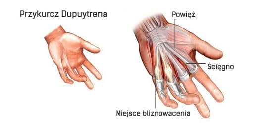 przykurcz dupuytrena