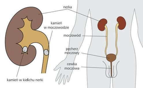 kamica nerkowa