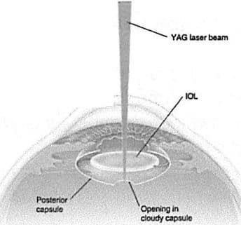 kapsulotomia laserowa