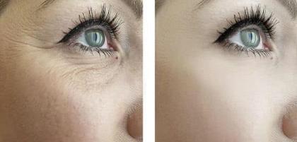 Operacje powiek. Charakterystyka