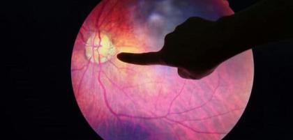 Czym jest retinopatia wcześniacza?